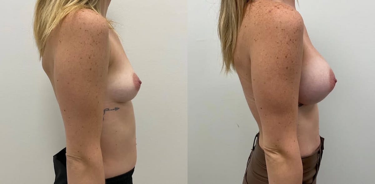 Breast Augmentation Before & After Gallery - Patient 427553 - Image 3