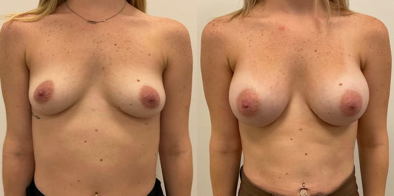 Breast Augmentation Before & After Gallery - Patient 427553 - Image 1
