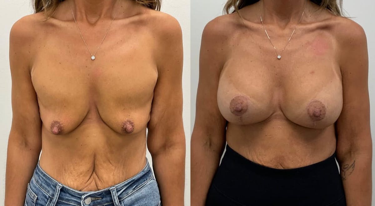 Breast Augmentation Before & After Gallery - Patient 361696 - Image 1