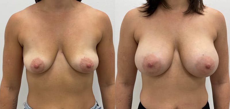 Breast Augmentation Before & After Gallery - Patient 323416 - Image 1