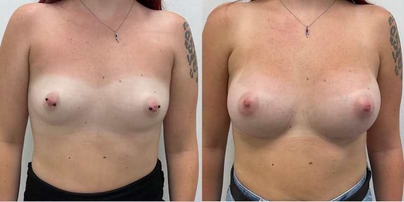 Breast Augmentation Before & After Gallery - Patient 225511 - Image 1