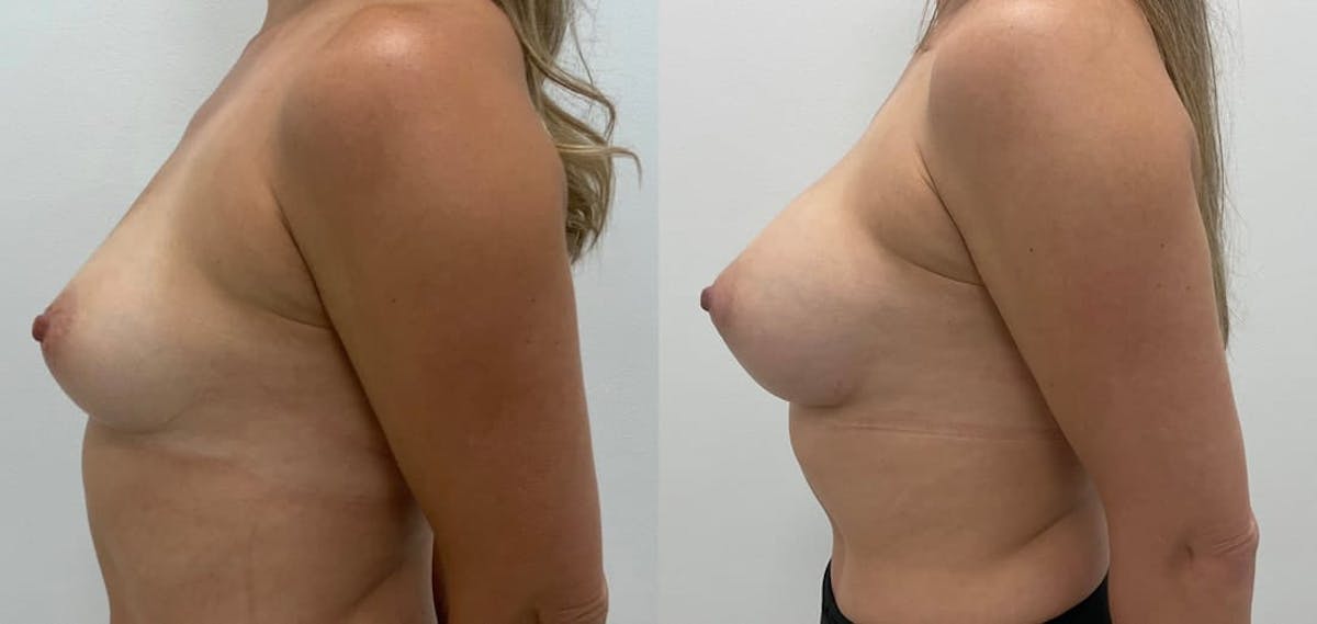 Breast Augmentation Before & After Gallery - Patient 306127 - Image 2