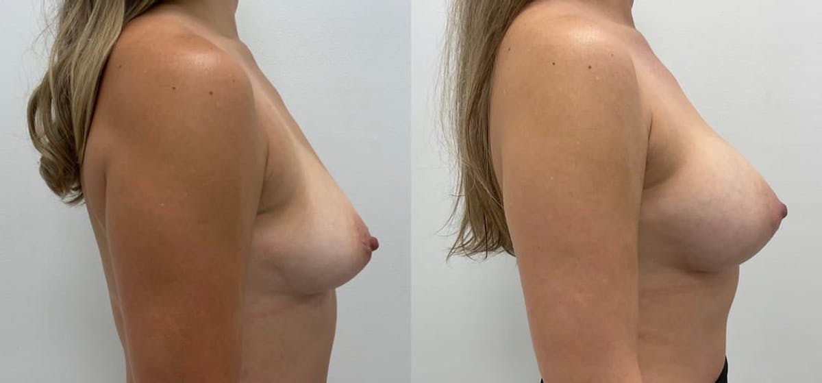 Breast Augmentation Before & After Gallery - Patient 306127 - Image 3
