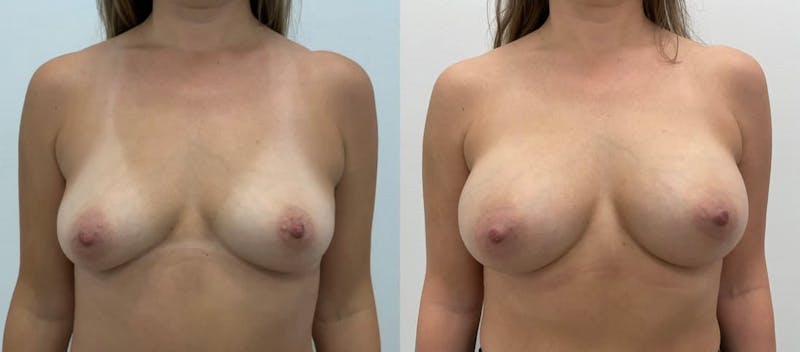 Breast Augmentation Before & After Gallery - Patient 306127 - Image 1