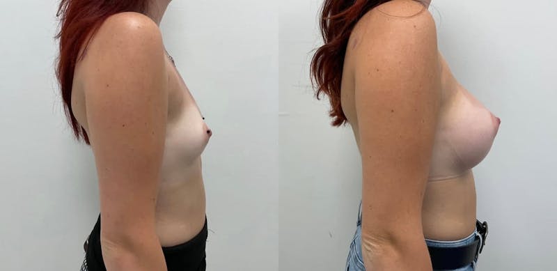 Breast Augmentation Before & After Gallery - Patient 255800 - Image 1