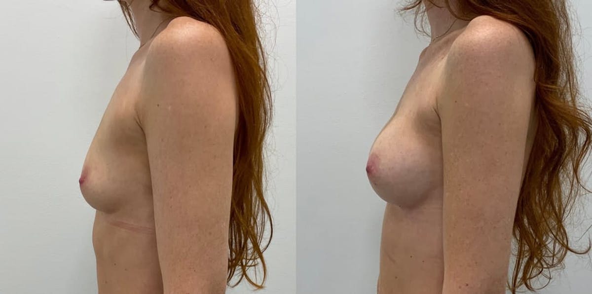 Breast Augmentation Before & After Gallery - Patient 325815 - Image 2