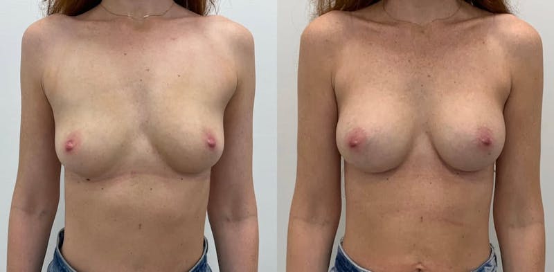 Breast Augmentation Before & After Gallery - Patient 325815 - Image 1