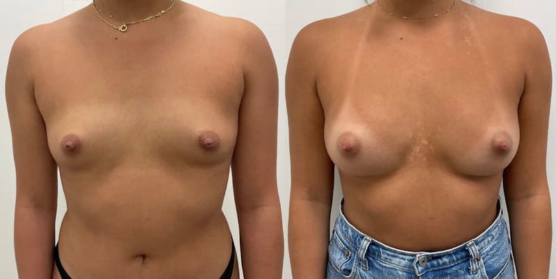 Breast Augmentation Before & After Gallery - Patient 298469 - Image 1