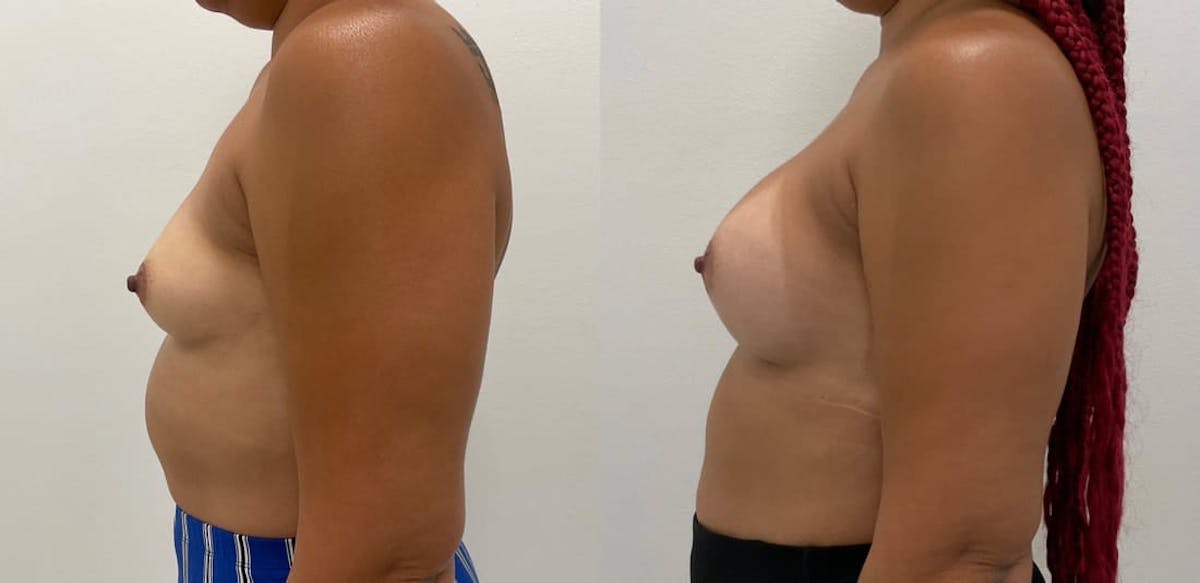 Breast Augmentation Before & After Gallery - Patient 283234 - Image 2
