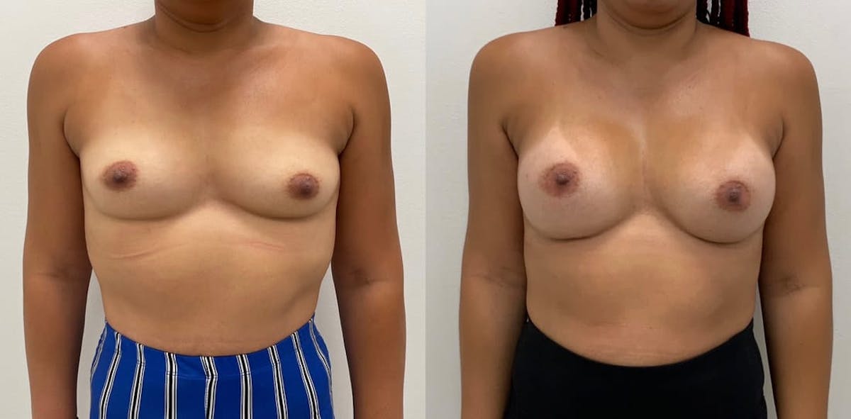 Breast Augmentation Before & After Gallery - Patient 283234 - Image 1