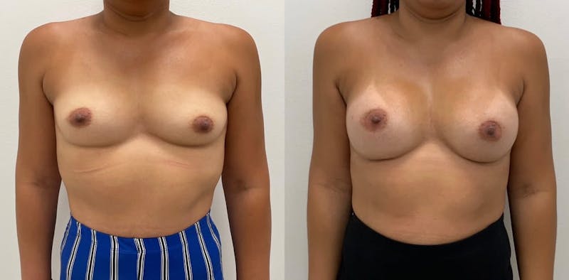 Breast Augmentation Before & After Gallery - Patient 283234 - Image 1