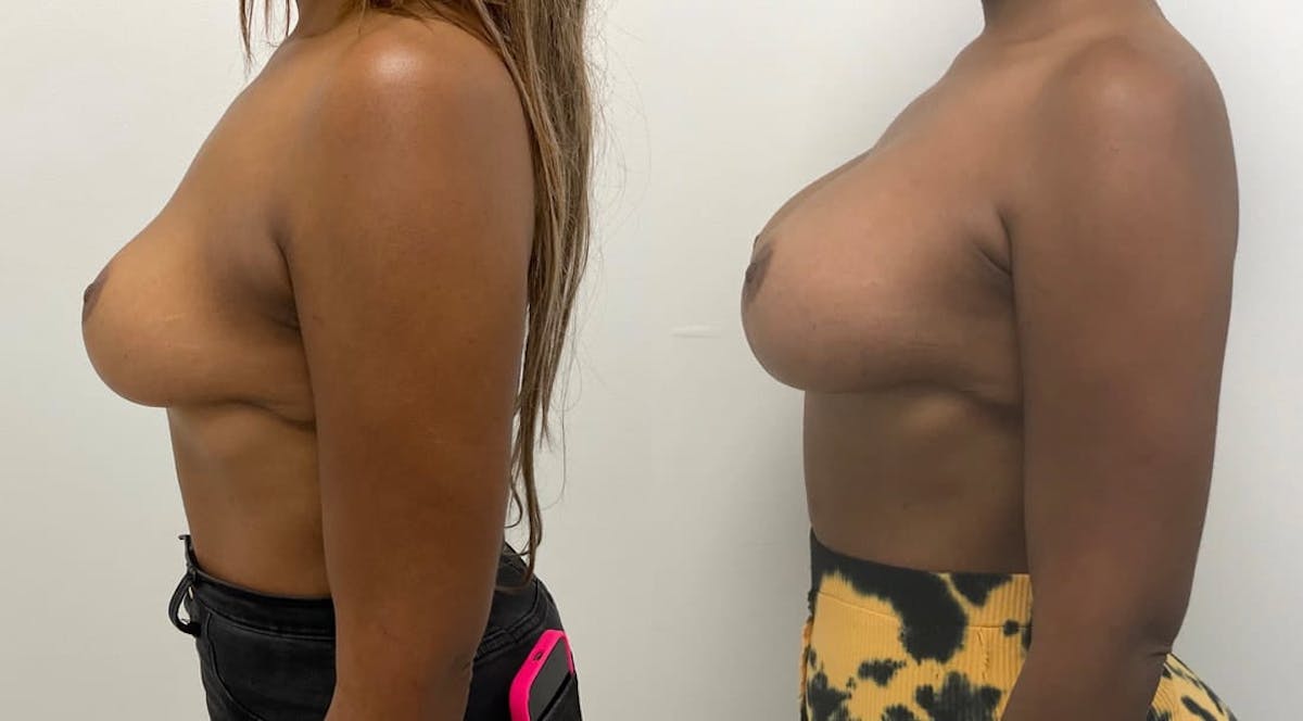 Breast Augmentation Before & After Gallery - Patient 370469 - Image 2