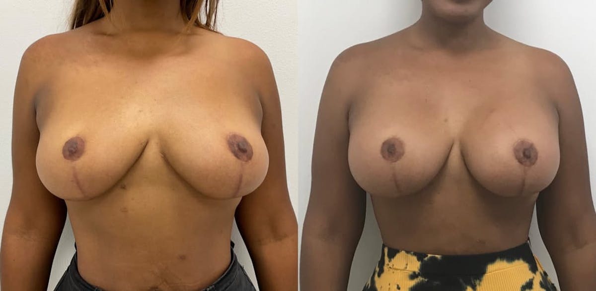 Breast Augmentation Before & After Gallery - Patient 370469 - Image 1