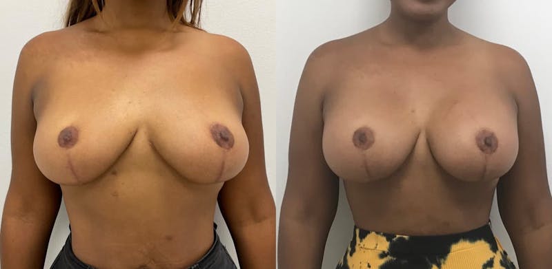 Breast Augmentation Before & After Gallery - Patient 370469 - Image 1