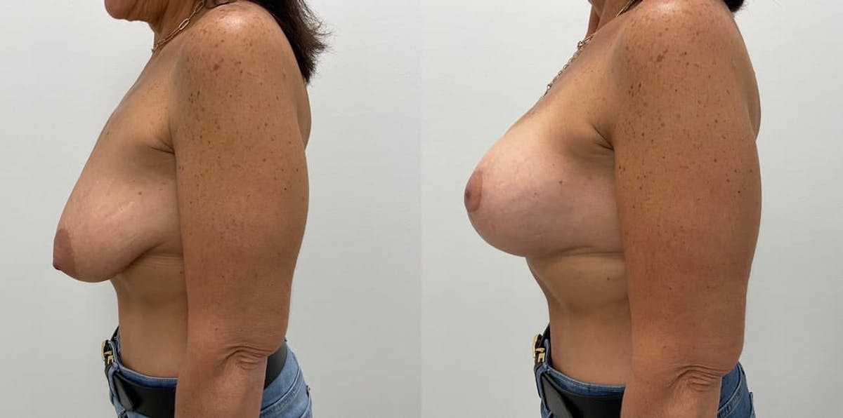 Breast Augmentation Before & After Gallery - Patient 412406 - Image 2