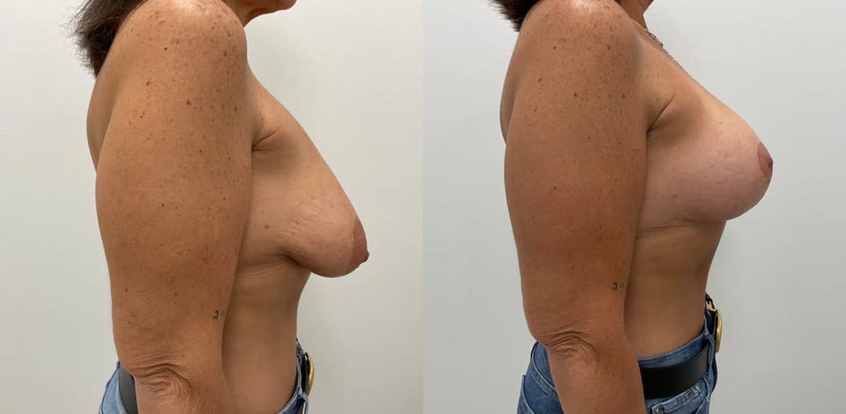 Breast Augmentation Before & After Gallery - Patient 412406 - Image 3