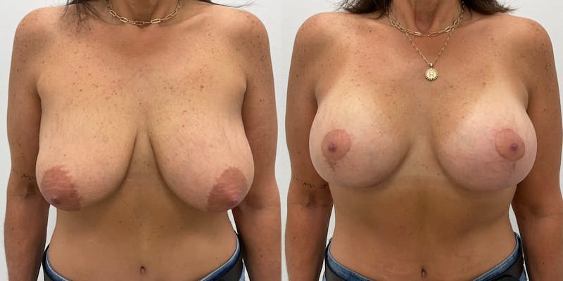 Breast Augmentation Before & After Gallery - Patient 412406 - Image 1