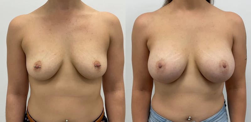 Breast Augmentation Before & After Gallery - Patient 225457 - Image 1