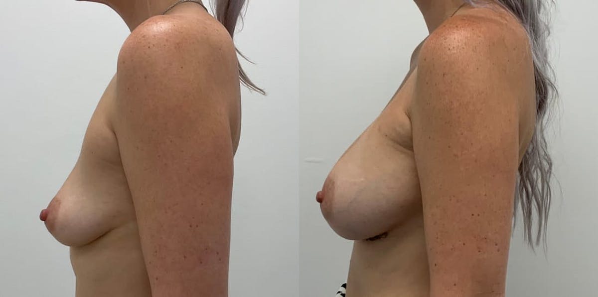 Breast Augmentation Before & After Gallery - Patient 264045 - Image 2