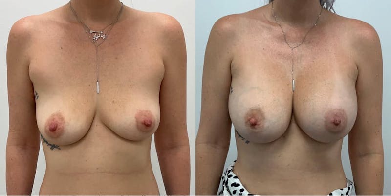 Breast Augmentation Before & After Gallery - Patient 264045 - Image 1