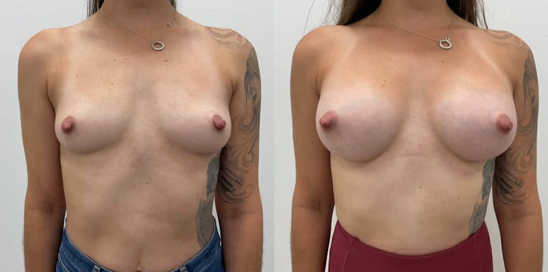 Breast Augmentation Before & After Gallery - Patient 965565 - Image 1