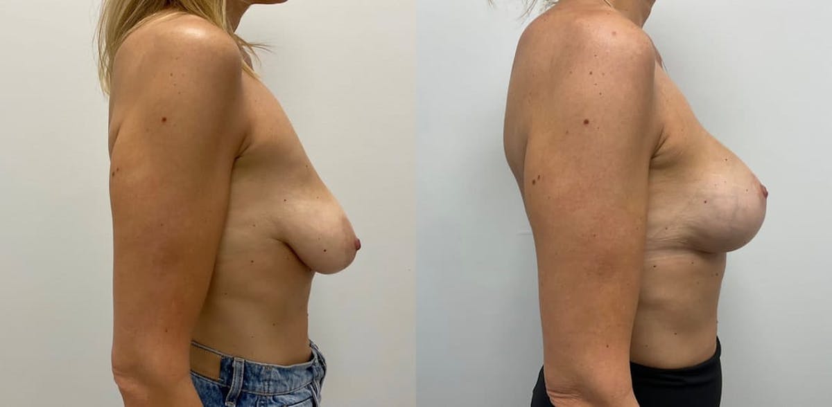 Breast Augmentation Before & After Gallery - Patient 211325 - Image 2