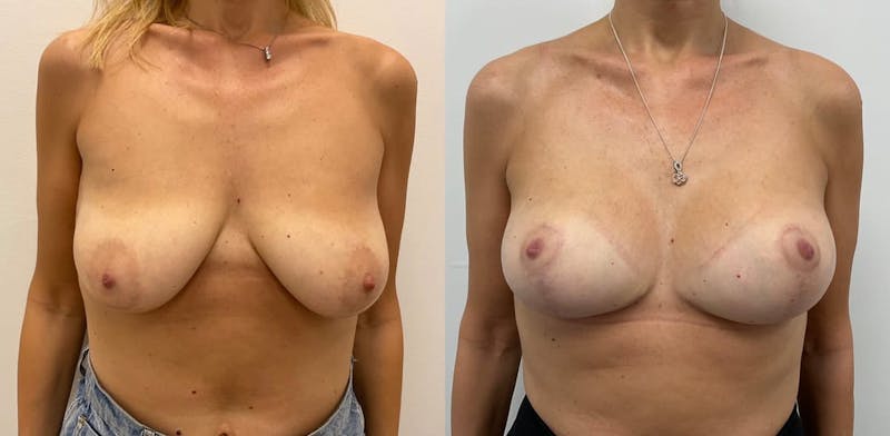Breast Augmentation Before & After Gallery - Patient 211325 - Image 1