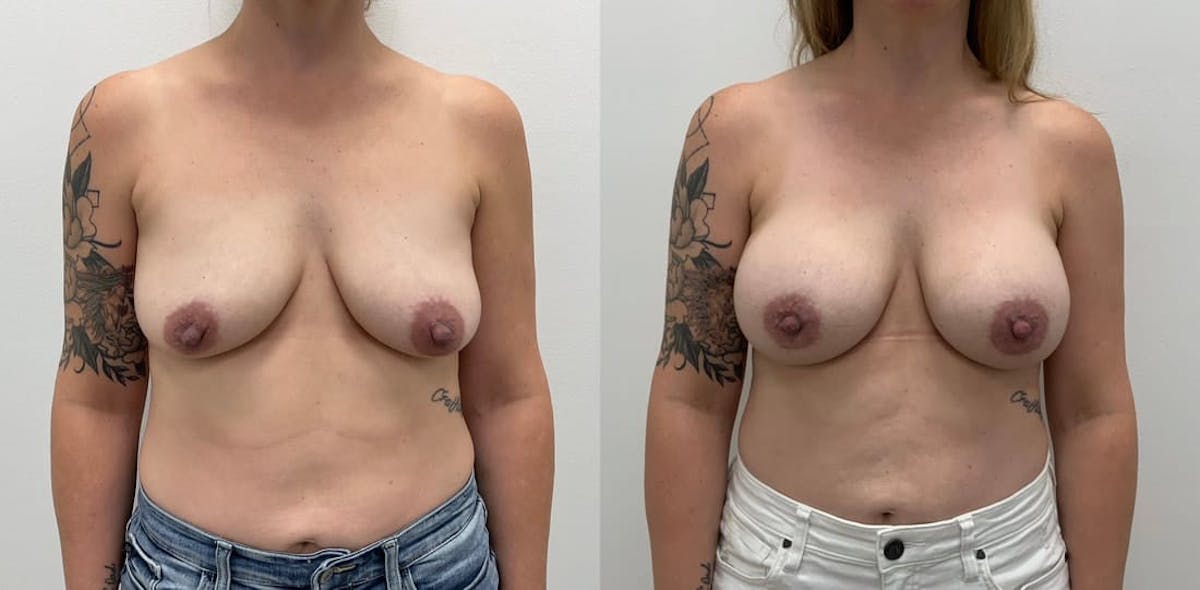 Breast Augmentation Before & After Gallery - Patient 147740 - Image 1