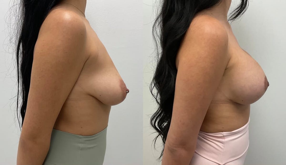 Breast Augmentation Before & After Gallery - Patient 416887 - Image 2