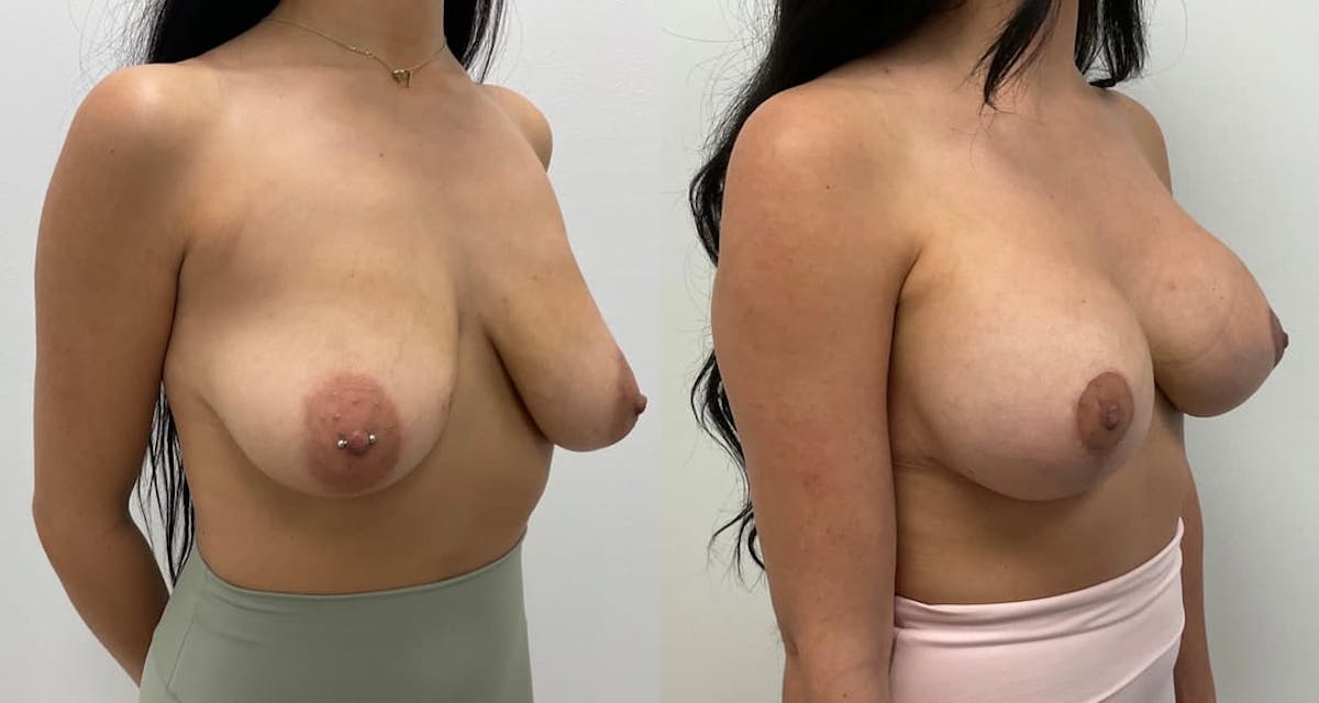 Breast Augmentation Before & After Gallery - Patient 416887 - Image 3