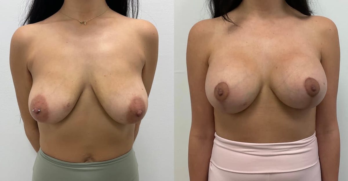 Breast Augmentation Before & After Gallery - Patient 416887 - Image 1