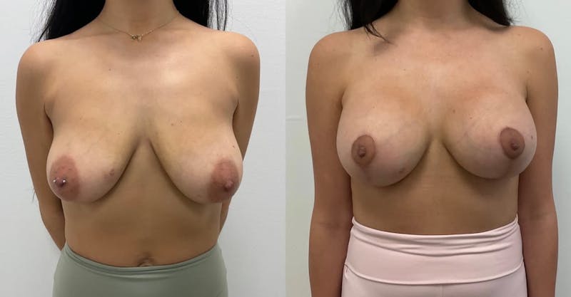 Breast Augmentation Before & After Gallery - Patient 416887 - Image 1