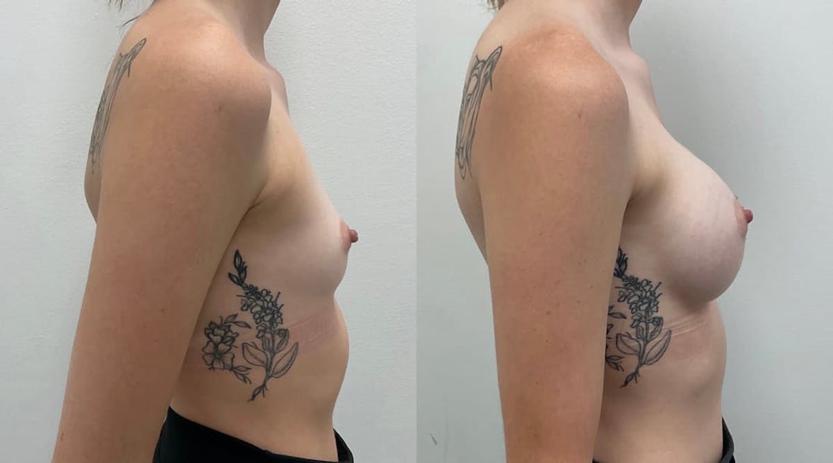 Breast Augmentation Before & After Gallery - Patient 261299 - Image 2