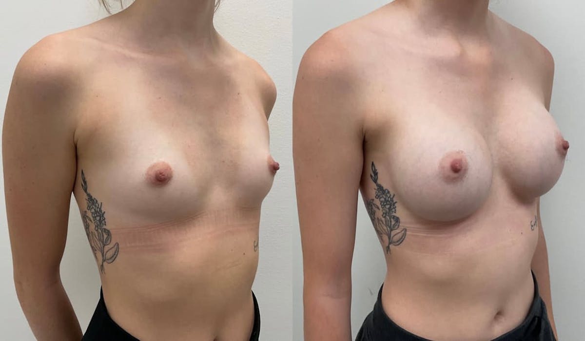 Breast Augmentation Before & After Gallery - Patient 261299 - Image 3
