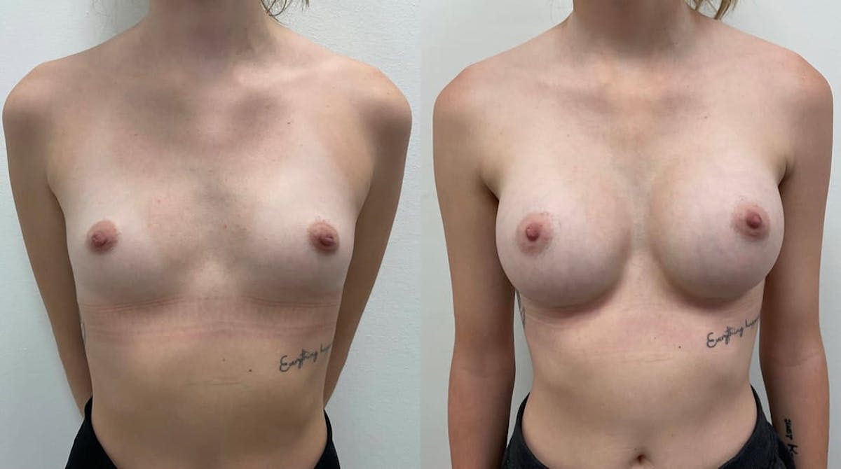 Breast Augmentation Before & After Gallery - Patient 261299 - Image 1