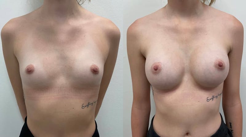 Breast Augmentation Before & After Gallery - Patient 261299 - Image 1