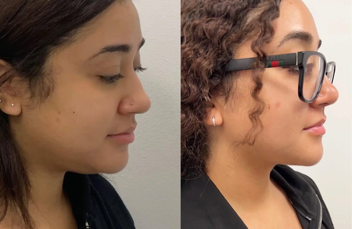Chin Liposuction Before & After Gallery - Patient 144324 - Image 1