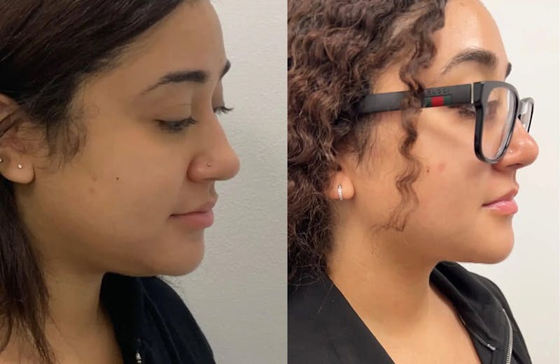Chin Liposuction Before & After Gallery - Patient 144324 - Image 1