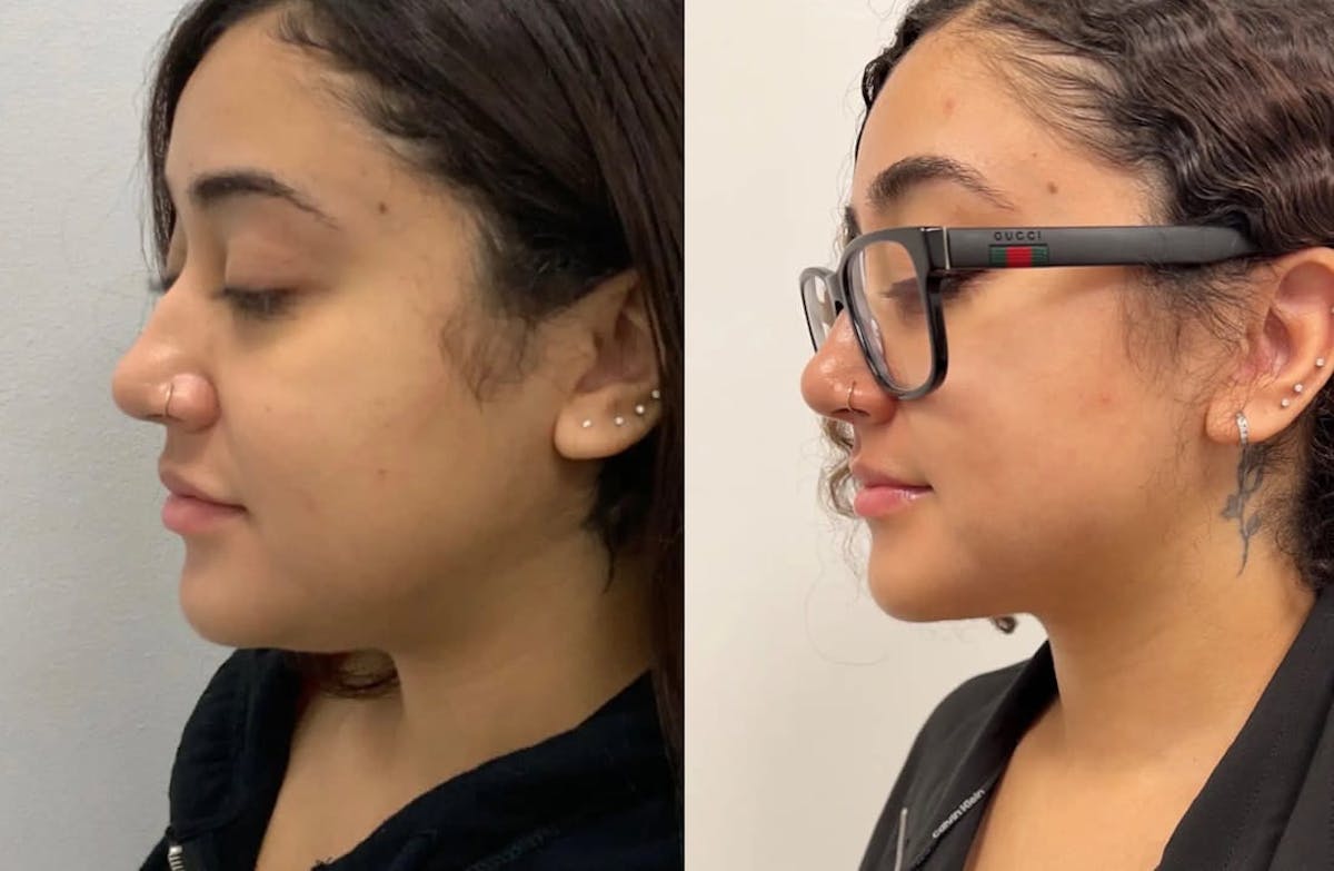Chin Liposuction Before & After Gallery - Patient 144324 - Image 2