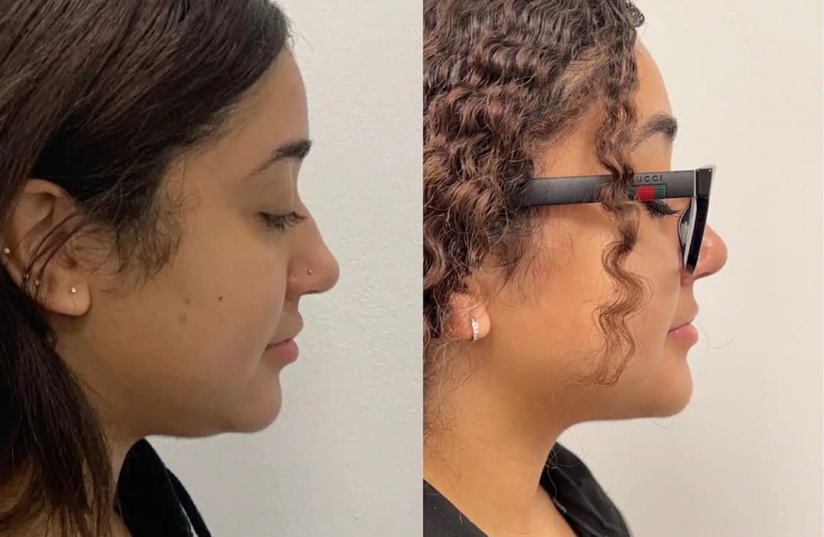 Chin Liposuction Before & After Gallery - Patient 144324 - Image 3