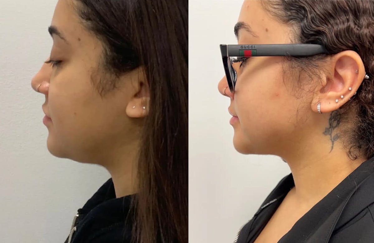 Chin Liposuction Before & After Gallery - Patient 144324 - Image 4