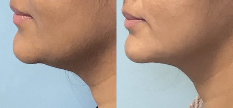 Chin Liposuction Before & After Gallery - Patient 346271 - Image 1