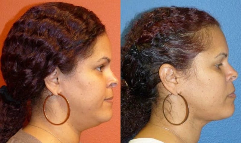 Chin Liposuction Before & After Gallery - Patient 385919 - Image 1