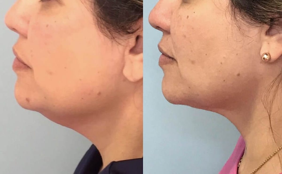 Chin Liposuction Before & After Gallery - Patient 110615 - Image 1