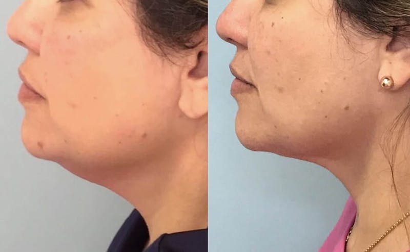 Chin Liposuction Before & After Gallery - Patient 110615 - Image 1