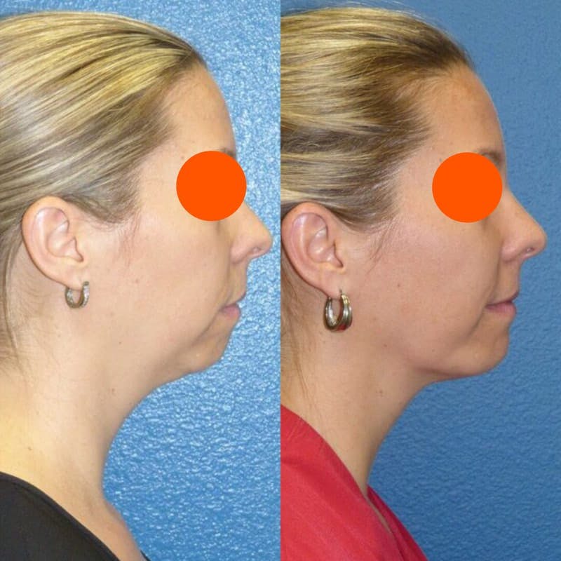 Chin Liposuction Before & After Gallery - Patient 406136 - Image 1