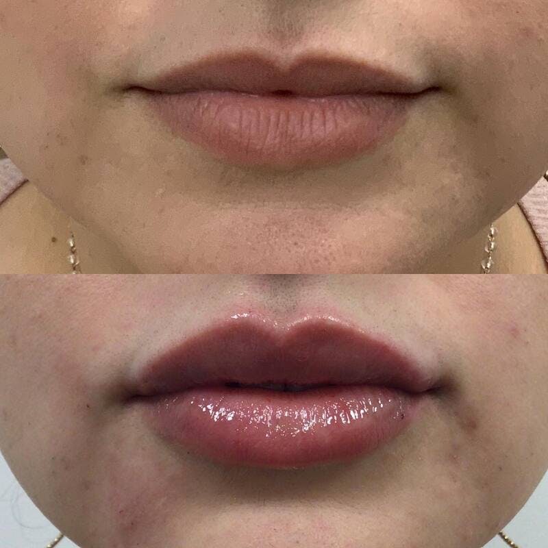 Lip Injections Before & After Gallery - Patient 207835 - Image 1