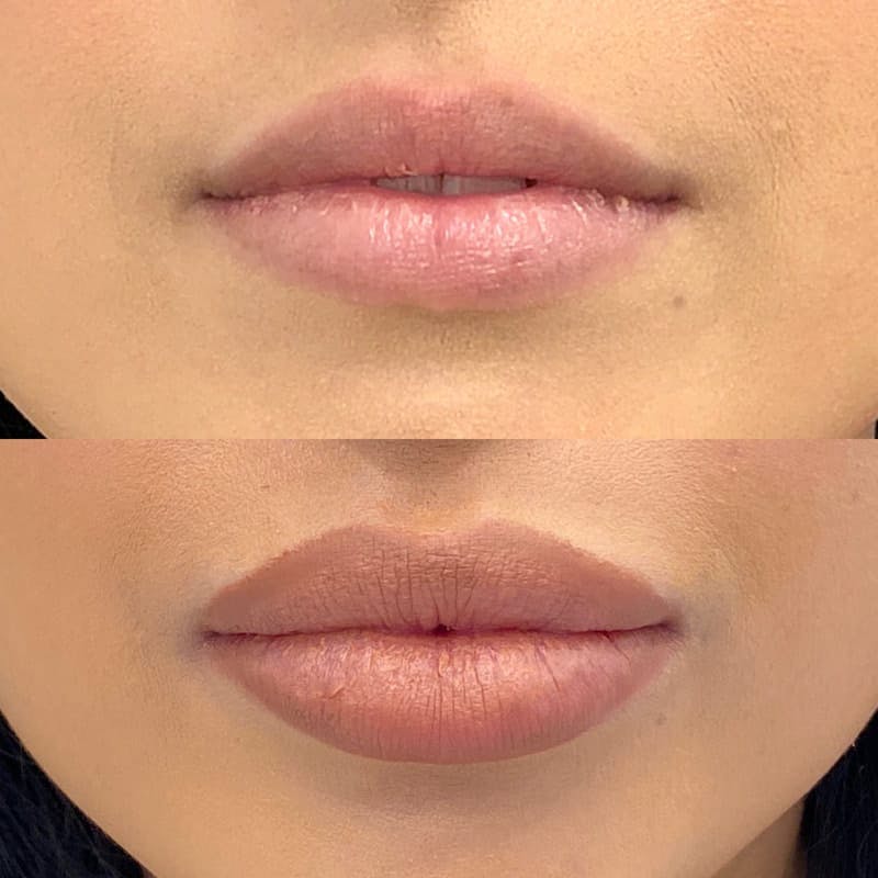 Lip Injections Before & After Gallery - Patient 275321 - Image 1