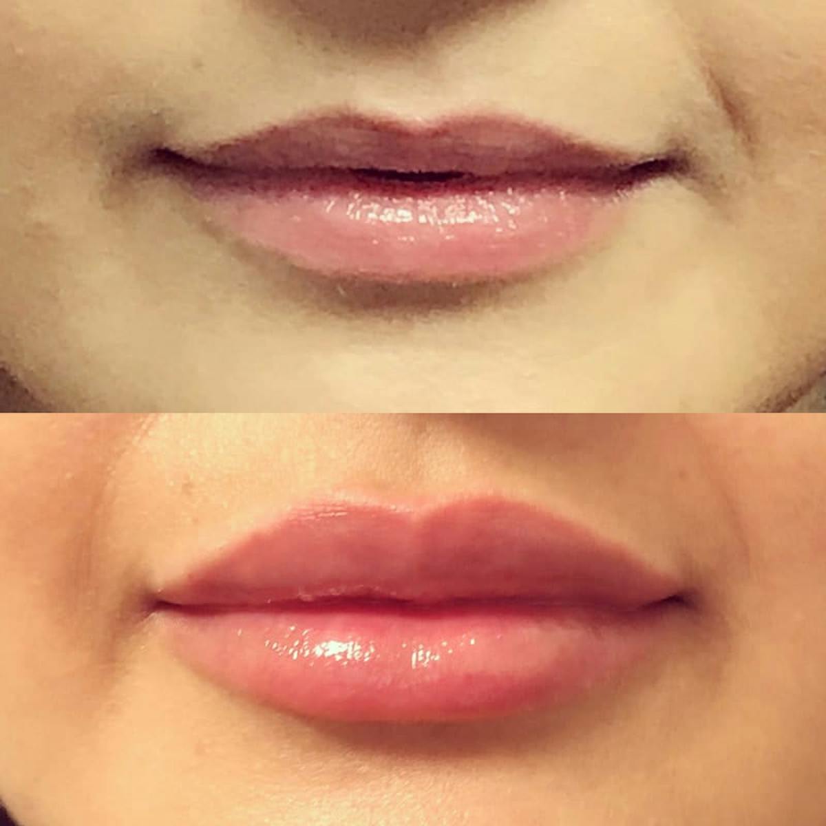 Lip Injections Before & After Gallery - Patient 651083 - Image 1