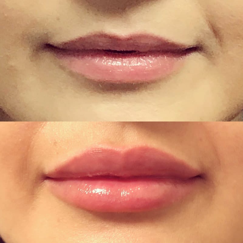 Lip Injections Before & After Gallery - Patient 651083 - Image 1